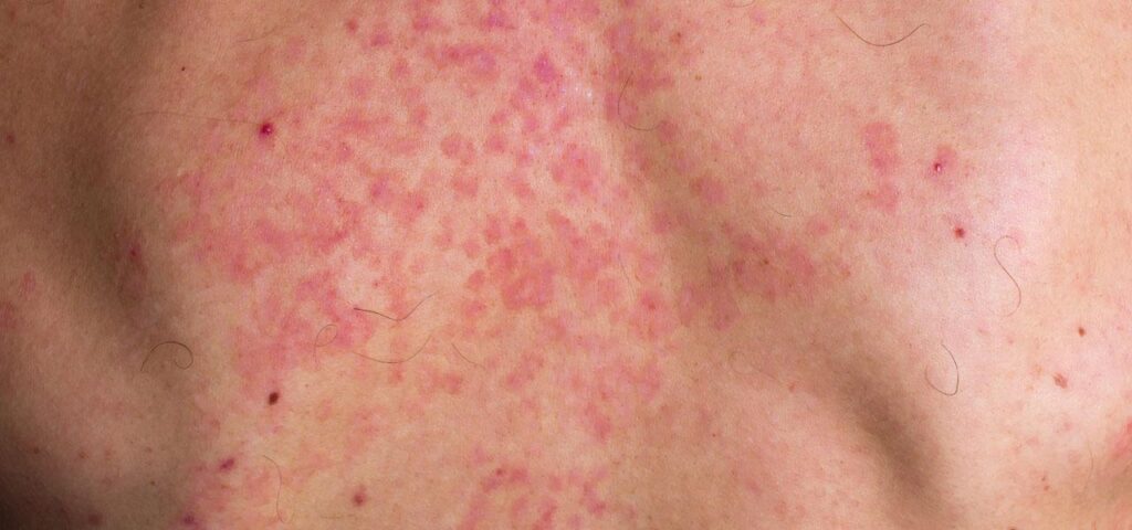 pityriasis versicolor on the back