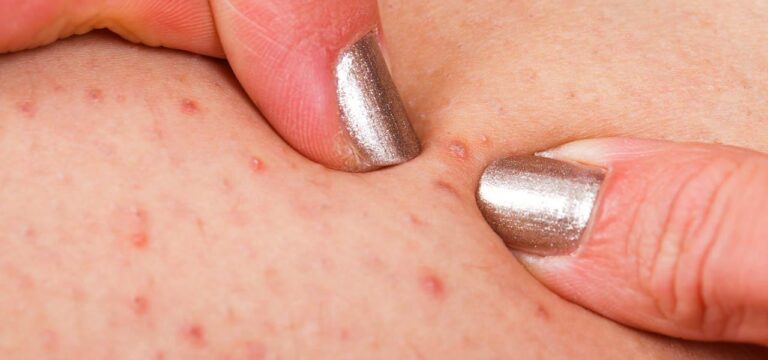 Folliculitis