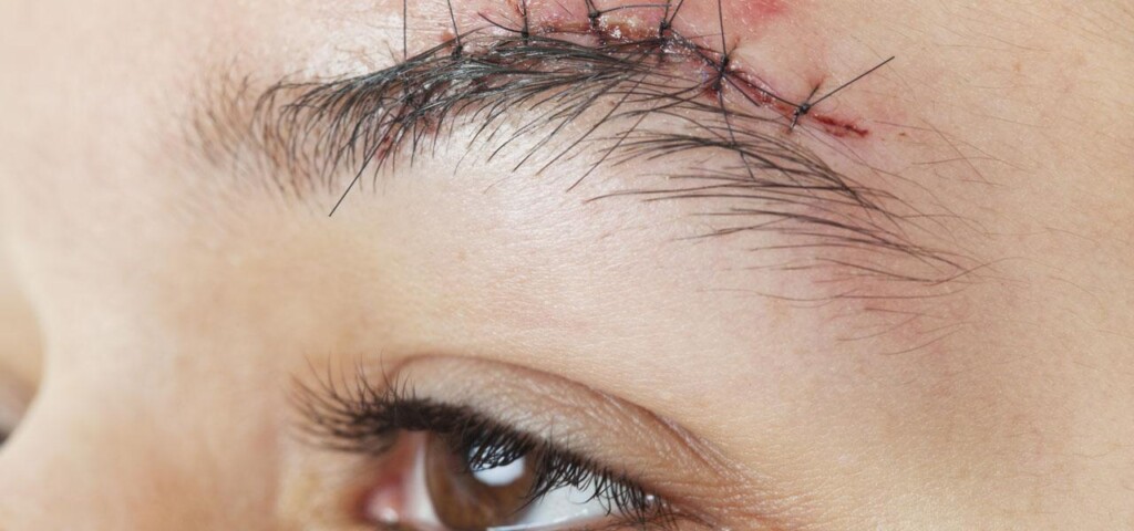 Hair transplantation in places of scars - eyebrows
