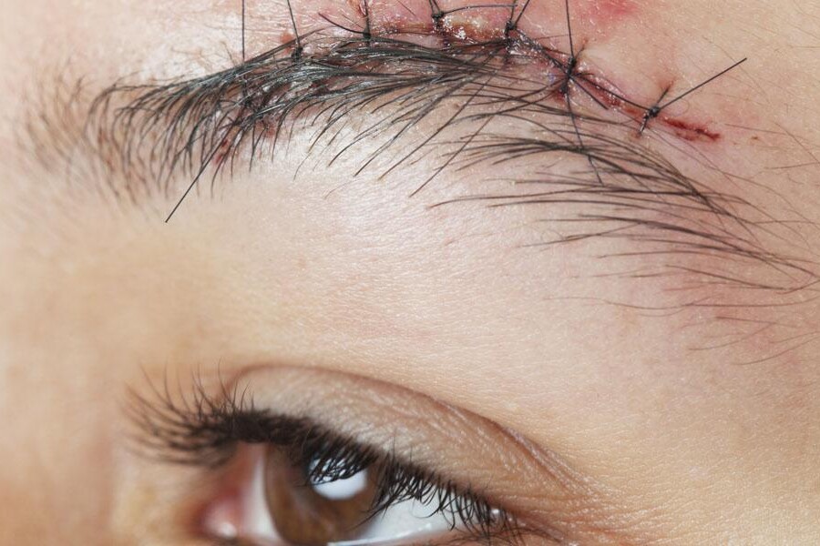 Przeszczep włosów w miejsce blizny - brwi