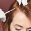 Carboxytherapy for hair