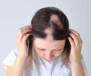 treatment of alopecia areata
