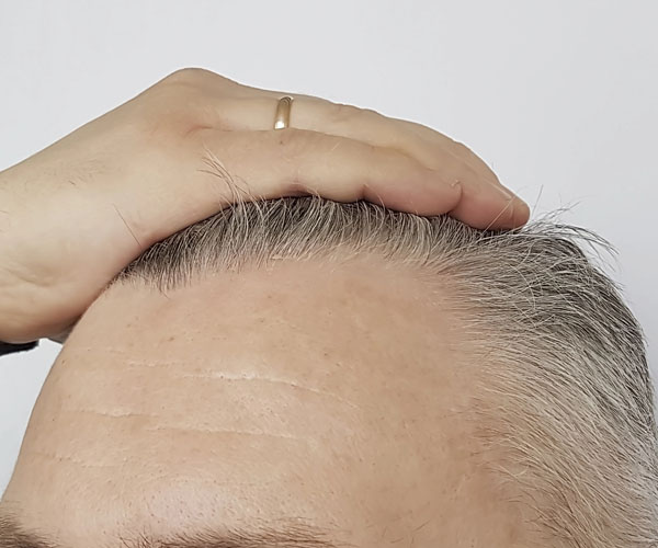 mezoterapia efekt po