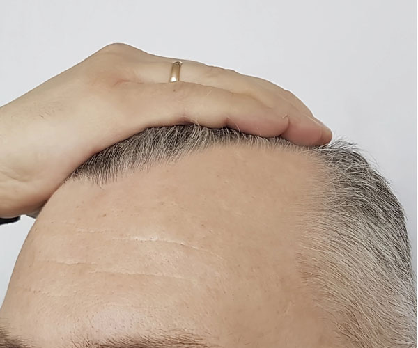mezoterapia efekt przed