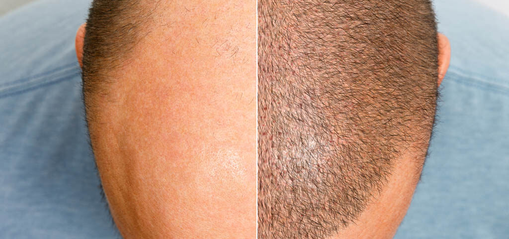 przeszczepianie włosów metodami fue waw