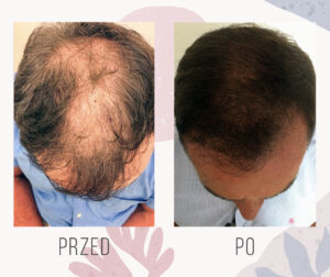 hair transplant 1818