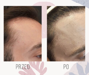 hair transplant 2000 1