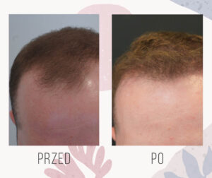 hair transplant 2000