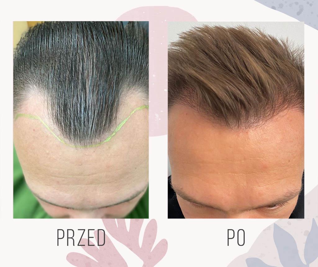 Hair transplant before and after - Dr Piotr Turkowski