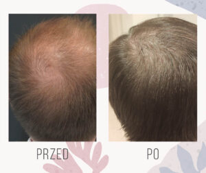 hair transplant 3000 1