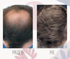 Około 3000 graftów