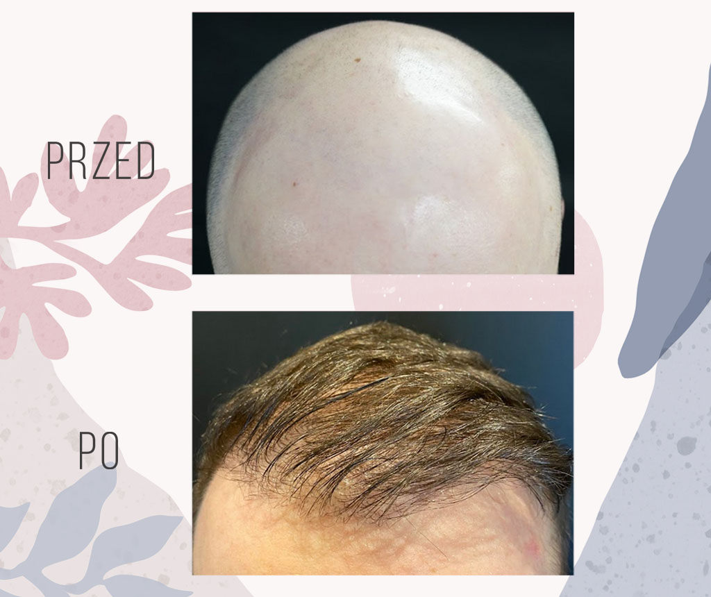 Hair transplant before and after - Dr Piotr Turkowski