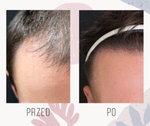 2641 graftów w okolicę zakoli