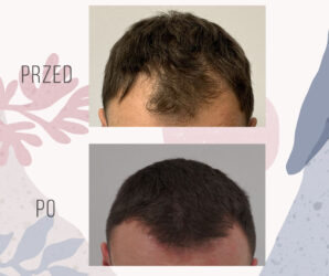 przeszczep włosów - efekt przed i po zabiegu - 1711 graftów