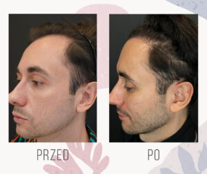 2398 graftów w zakola