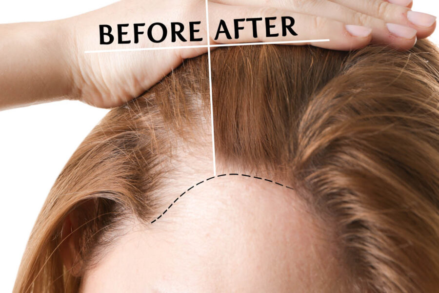 przeszczep włosów bez konieczności golenia włosów