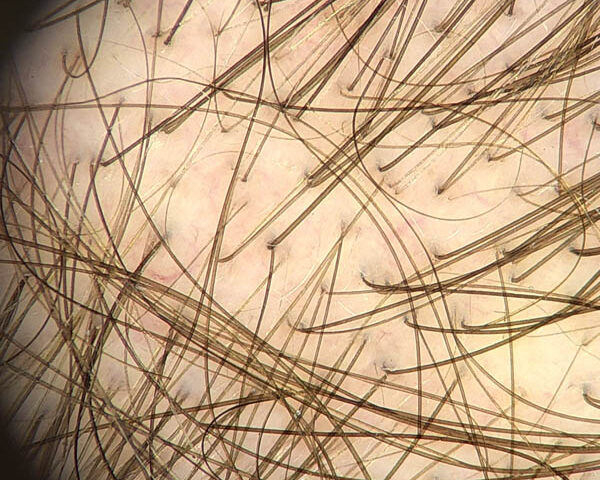 zdjęcie trichoskopowe