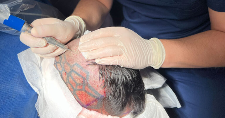 Lekarz wykonujący precyzyjny przeszczep włosów metodą FUE Unshaven bez golenia głowy w PT CLINIC w Warszawie