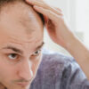 jak uniknąć nieudanego przeszczepu włosów