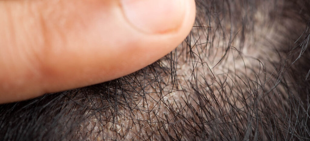 seborrheic alopecia