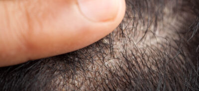 łysienie łojotokowe