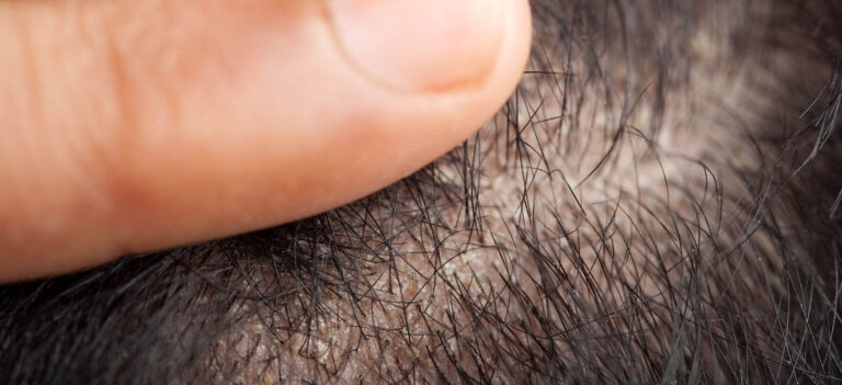 seborrheic alopecia