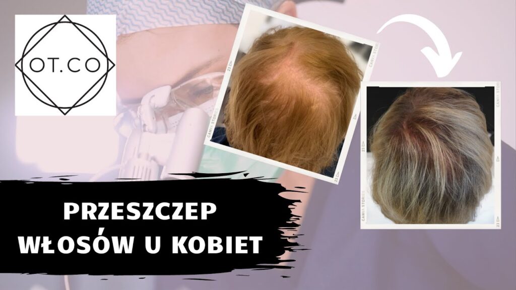 Przeszczep włosów u kobiet – wskazania, kwalifikacja i efekty