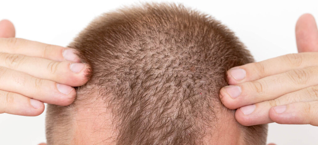 What is DHT and how does it affect the male body?