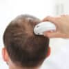 scalp hair examination