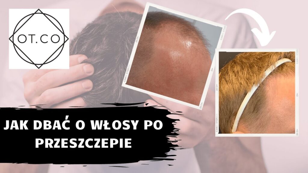 Jak dbać o włosy po przeszczepie?