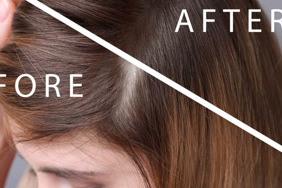 kobieta przed po leczenie trychologiczne efekty