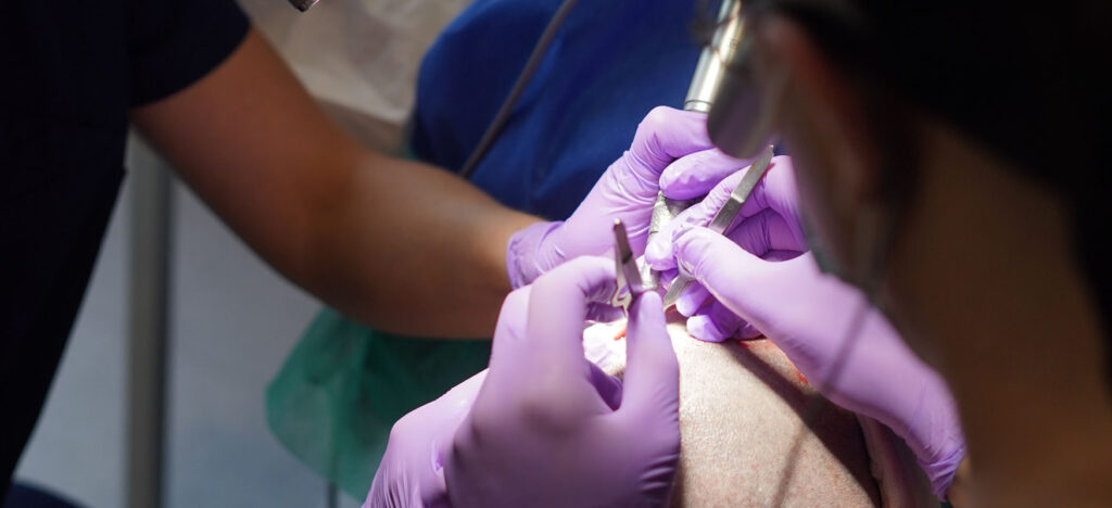 tools during hair transplantation