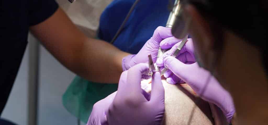 Hair transplant tools