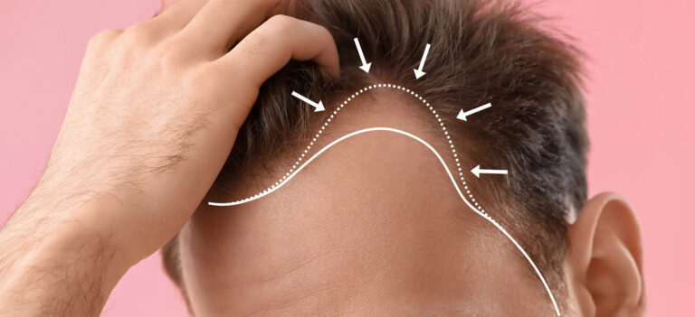 second hair transplant procedure