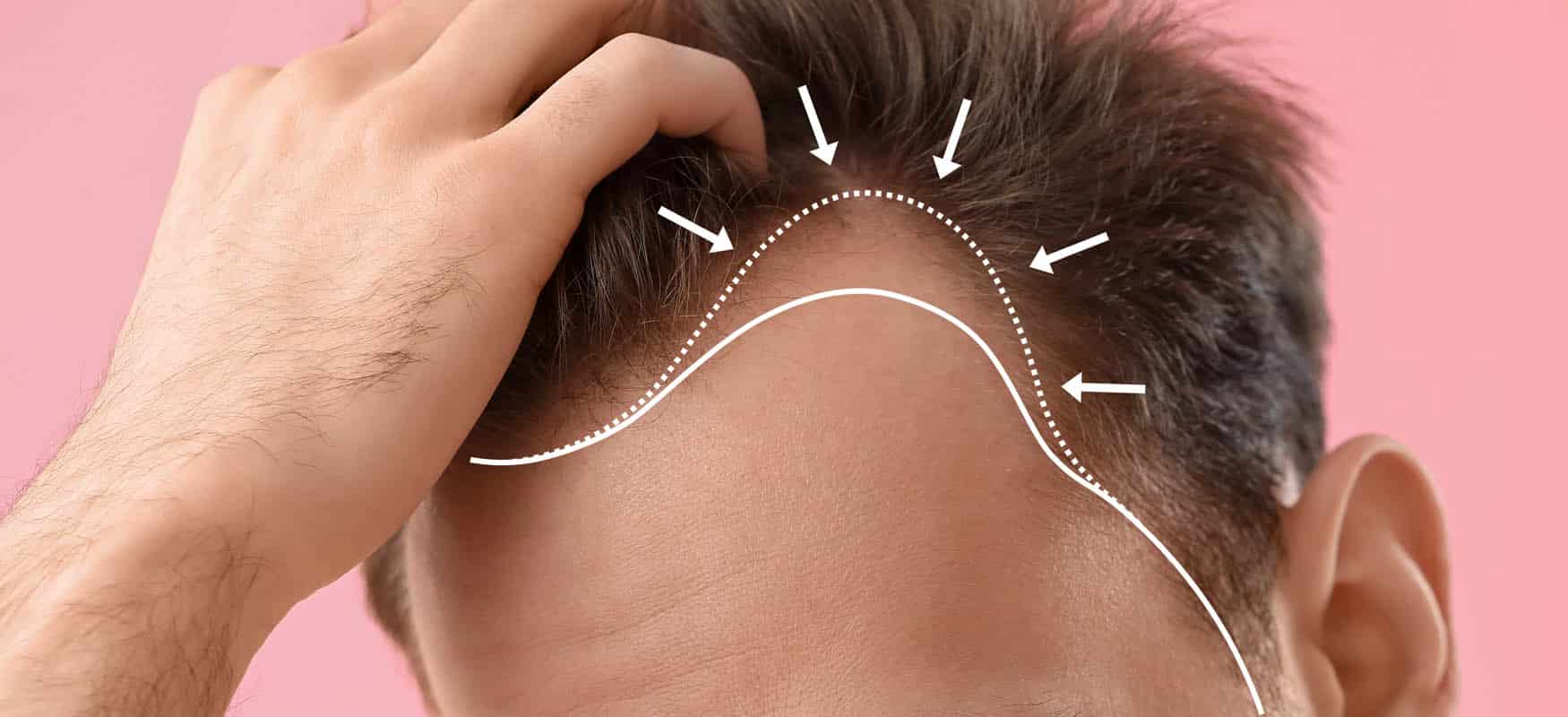 drugi zabieg przeszczepu wlosow