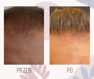 efekt po 13 miesiacach