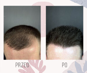 efekt przed i po roku od przeszczepu