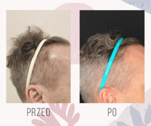 efekt przeszczepu fue boczna linia 1500 graftow 11 miesiecy