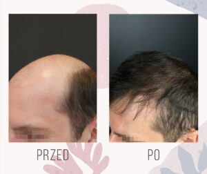 Przeszczep włosów FUE 3800 graftów odbudowa całkowitej utraty owłosienia efekt po 12 miesiącach