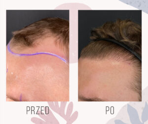 Efekt przeszczepu włosów FUE – nowa linia włosów po 2463 graftach, zdjęcie przed i po 12 miesiącach