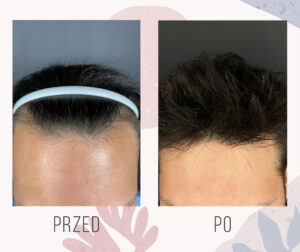Efekt przeszczepu FUE u mężczyzny 2000 graftów 7 miesięcy po zabiegu odbudowa linii włosów