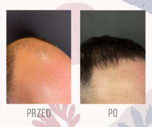 Efekt przeszczepu FUE 2700 graftów odbudowa zakoli 11 miesięcy po zabiegu