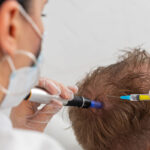 egzosomy na wlosy terapia