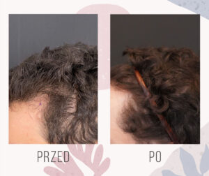 zageszczenie zakoli 9 miesiecy po