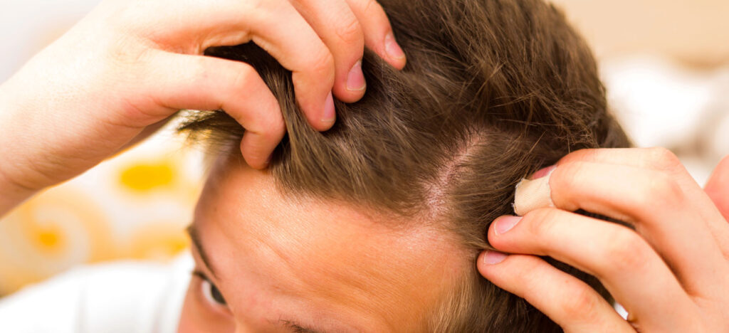 Seasonal Hair Loss: Causes and Treatments