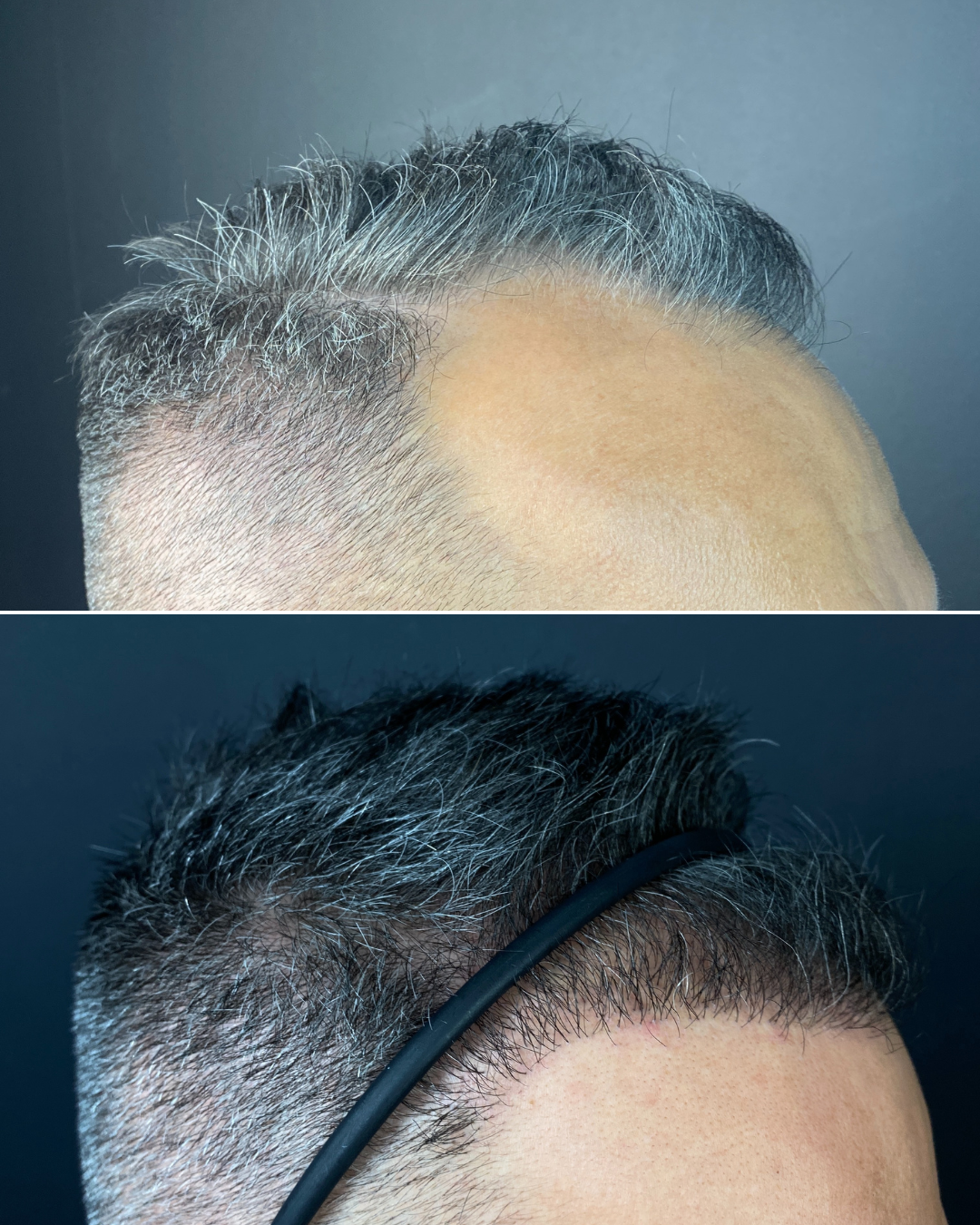 Crown thickening and temple point filling, 2,998 grafts, 12 months – Piotr Turkowski