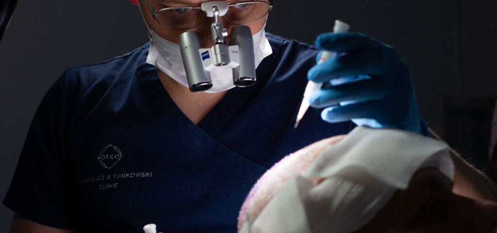 Pióro Choi i implanter do przeszczepu włosów DHI Zbliżenie na narzędzie typu pióro Choi wykorzystywane do precyzyjnej implantacji mieszków włosowych w technice DHI
