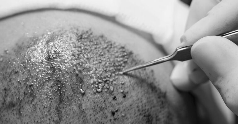 Lekarz wykonujący bezpośrednią implantację graftów metodą DHI w klinice w Warszawie